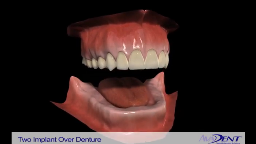 Implants to Stabilize Dentures