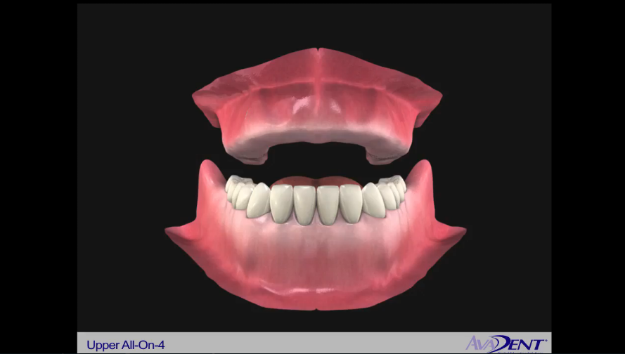 Implants to Support a Fixed Denture